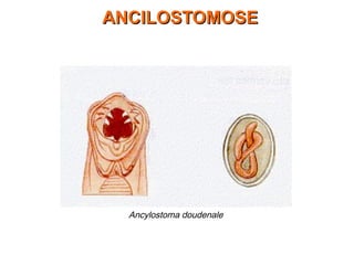 Ancylostoma doudenale
ANCILOSTOMOSEANCILOSTOMOSE
 