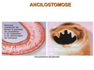 Ancylostoma doudenale
ANCILOSTOMOSEANCILOSTOMOSE
 