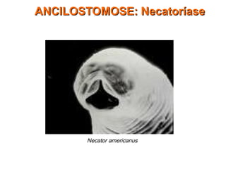 ANCILOSTOMOSE: NecatoríaseANCILOSTOMOSE: Necatoríase
Necator americanus
 
