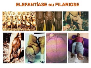 ELEFANTÍASE ou FILARIOSEELEFANTÍASE ou FILARIOSE
 