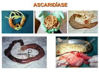 ASCARIDÍASEASCARIDÍASE
 