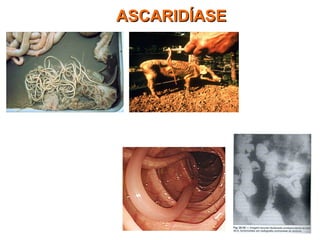 No porco
No reto humano
ASCARIDÍASEASCARIDÍASE
 
