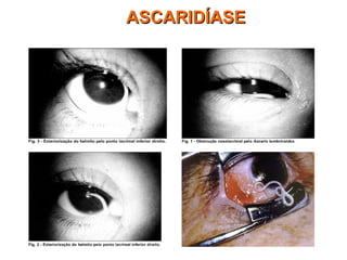 ASCARIDÍASEASCARIDÍASE
 