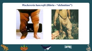 Wuchereria bancrofti (filária - “elefantíase”)
 