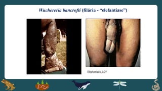 Wuchereria bancrofti (filária - “elefantíase”)
 
