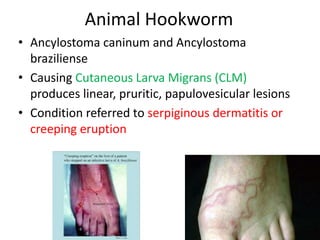 Animal Hookworm
• Ancylostoma caninum and Ancylostoma
braziliense
• Causing Cutaneous Larva Migrans (CLM)
produces linear, pruritic, papulovesicular lesions
• Condition referred to serpiginous dermatitis or
creeping eruption
 