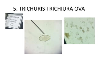 5. TRICHURIS TRICHIURA OVA
 