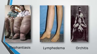 • Elephantiasis
Elephantiasis Lymphedema Orchitis
 