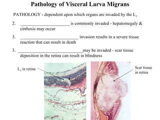Pathology of Visceral Larva Migrans PATHOLOGY - dependent upon which organs are invaded by the L 3 ______________________ is commonly invaded - hepatomegaly & cirrhosis may occur __________________________ invasion results in a severe tissue reaction that can result in death 3.  _____________________________may be invaded - scar tissue deposition in the retina can result in blindness   Scar tissue in retina L 3  in retina 