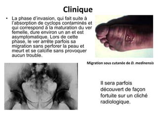 Clinique
• La phase d’invasion, qui fait suite à
  l’absorption de cyclops contaminés et
  qui correspond à la maturation du ver
  femelle, dure environ un an et est
  asymptomatique. Lors de cette
  phase, le ver arrête parfois sa
  migration sans perforer la peau et
  meurt et se calcifie sans provoquer
  aucun trouble.
                                    Migration sous cutanée de D. medinensis




                                           Il sera parfois
                                           découvert de façon
                                           fortuite sur un cliché
                                           radiologique.
 