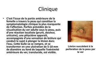 Clinique
• C’est l’issue de la partie antérieure de la
  femelle a travers la peau qui constitue la
  symptomatologie clinique la plus marquante
  de l’affection. Parfois précédée de la
  visualisation du ver adulte sous la peau, puis
  d’une réaction localisée (prurit, douleur,
  urticaire), une phlyctène apparaît,
  accompagnée d’une sensation de brûlure qui
  conduit le sujet à plonger la lésion dans
  l’eau. Cette bulle va se rompre, et se
  transformer en une ulcération de 5-10 mm           Lésion succédant à la
  de diamètre au fond de laquelle l’extrémité      perforation de la peau par
  antérieure du ver, translucide, est visible.               le ver
 