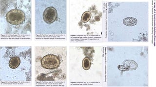 ASCARIS LUMBRICOIDES et ASCARIDIOSE
5) DIAGNOSTIC BIOLOGIQUE:
Stade II : diagnostic de certitude par mise en évidence des
œufs dans les selles.
*les œufs fécondés sont caractéristiques, ovoides, +/-
arrondies , 50-60/45 µm (long/large) entourés d’une double
membrane
-une membrane externe épaisse, jaune brun, mamelonnée
-interne lisse et épaisse
*Les œufs non fécondés sont atypiques, plus grands,
allongés et souvent dépourvus de coque externe
(décortiqués)
*lors d’une infestation monosexuée male , l’examen
coprologique est négatif.
*les adultes , si éliminés par les fèces sont acilement
identifiables
 