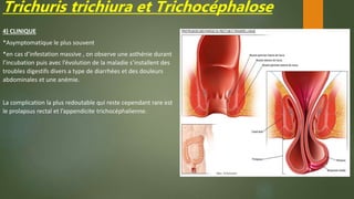 Trichuris trichiura et Trichocéphalose
4) CLINIQUE
*Asymptomatique le plus souvent
*en cas d’infestation massive , on observe une asthénie durant
l’incubation puis avec l’évolution de la maladie s’installent des
troubles digestifs divers a type de diarrhées et des douleurs
abdominales et une anémie.
La complication la plus redoutable qui reste cependant rare est
le prolapsus rectal et l’appendicite trichocéphalienne.
 