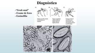 Diagnóstico
- Exame de fezes
- Eosinofilia
-“Swab anal”
 