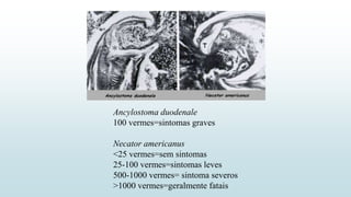 Ancylostoma duodenale
100 vermes=sintomas graves
Necator americanus
<25 vermes=sem sintomas
25-100 vermes=sintomas leves
500-1000 vermes= sintoma severos
>1000 vermes=geralmente fatais
 