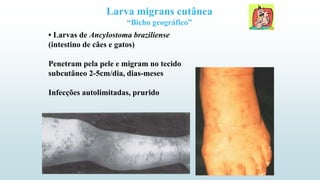 • Larvas de Ancylostoma braziliense
(intestino de cães e gatos)
Penetram pela pele e migram no tecido
subcutâneo 2-5cm/dia, dias-meses
Infecções autolimitadas, prurido
Larva migrans cutânea
“Bicho geográfico”
 