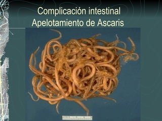 Complicación intestinal
Apelotamiento de Ascaris
 