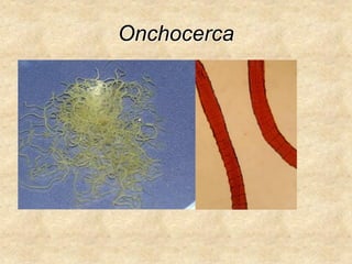 Onchocerca
 