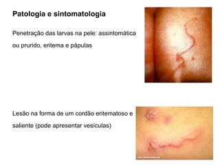Patologia e sintomatologia
Penetração das larvas na pele: assintomática
ou prurido, eritema e pápulas
Lesão na forma de um cordão eritematoso e
saliente (pode apresentar vesículas)
 