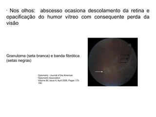 •
Nos olhos: abscesso ocasiona descolamento da retina e
opacificação do humor vítreo com consequente perda da
visão
Optometry - Journal of the American
Optometric Association
Volume 80, Issue 4, April 2009, Pages 175-
180
Granuloma (seta branca) e banda fibrótica
(setas negras)
 