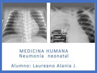 MEDICINA HUMANA
Neumonía neonatal
Alumno: Laureano Alania J.
 