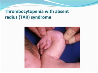Thrombocytopenia with absent
radius (TAR) syndrome
 