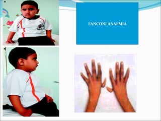 FANCONI ANAEMIA
 