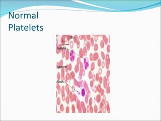 Normal
Platelets
 