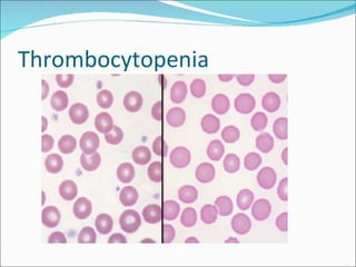 Thrombocytopenia
 