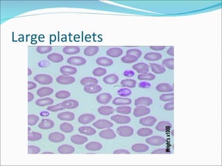 Large platelets
 