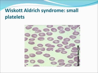 Wiskott Aldrich syndrome: small
platelets
 