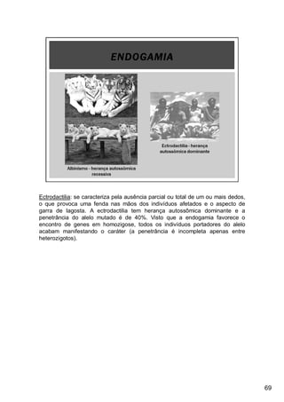 Ectrodactilia: se caracteriza pela ausência parcial ou total de um ou mais dedos,
o que provoca uma fenda nas mãos dos indivíduos afetados e o aspecto de
garra de lagosta. A ectrodactilia tem herança autossômica dominante e a
penetrância do alelo mutado é de 40%. Visto que a endogamia favorece o
encontro de genes em homozigose, todos os indivíduos portadores do alelo
acabam manifestando o caráter (a penetrância é incompleta apenas entre
heterozigotos).
69
 
