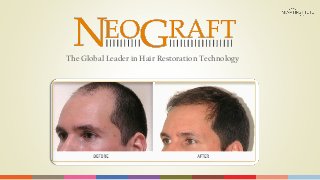 The Global Leader in Hair Restoration Technology

 