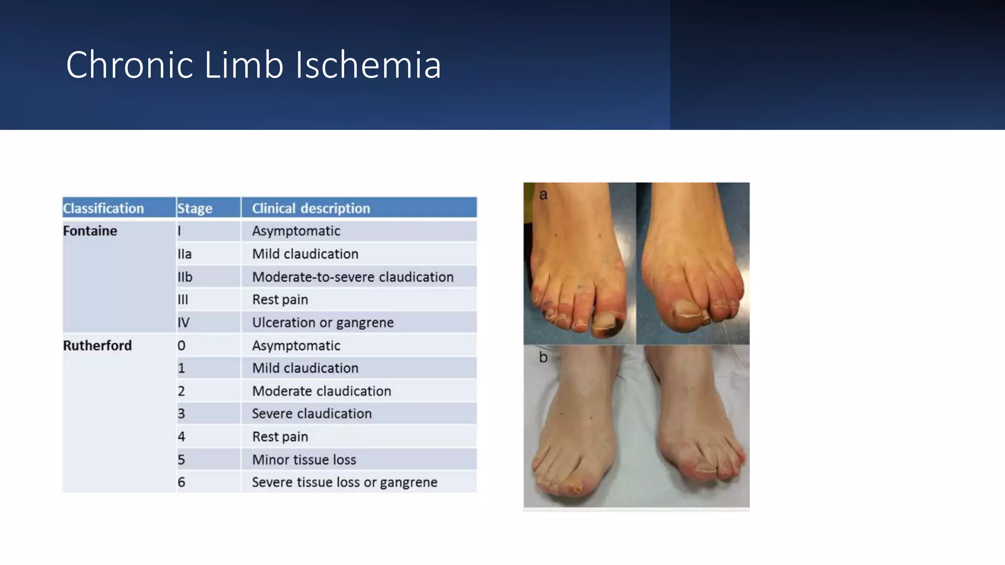 Neo innovation in Limb Ischemia Management | PPSX
