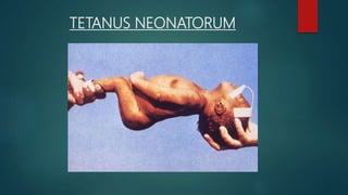TETANUS NEONATORUM
 