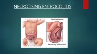 NECROTISING ENTROCOLITIS
 