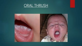 ORAL THRUSH
 