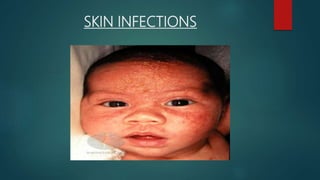 SKIN INFECTIONS
 