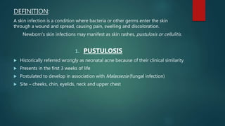 DEFINITION:
A skin infection is a condition where bacteria or other germs enter the skin
through a wound and spread, causing pain, swelling and discoloration.
Newborn’s skin infections may manifest as skin rashes, pustulosis or cellulitis.
1. PUSTULOSIS
 Historically referred wrongly as neonatal acne because of their clinical similarity
 Presents in the first 3 weeks of life
 Postulated to develop in association with Malassezia (fungal infection)
 Site – cheeks, chin, eyelids, neck and upper chest
 