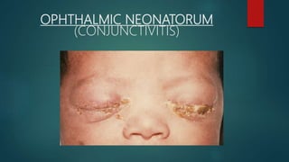 OPHTHALMIC NEONATORUM
(CONJUNCTIVITIS)
 