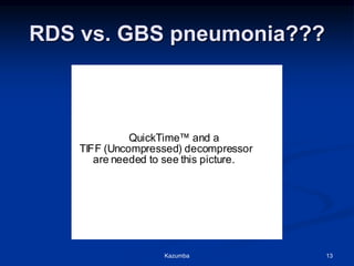 RDS vs. GBS pneumonia???
QuickTime™ and a
TIFF (Uncompressed) decompressor
are needed to see this picture.
Kazumba 13
 