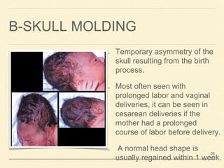 Positional Molding Neonatal examination | PPTX