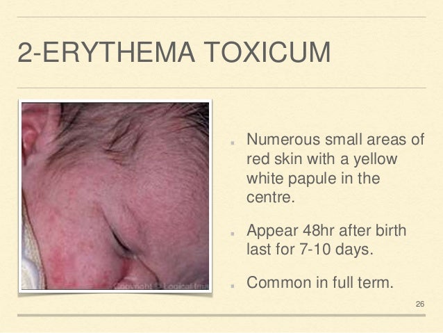 Pediatric Erythema Toxicum: Background, Pathophysiology ...