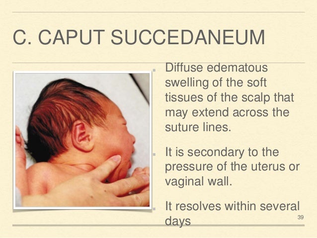 Why Is A Neonate’s Head More “moldable”? Neonatal 20 examination