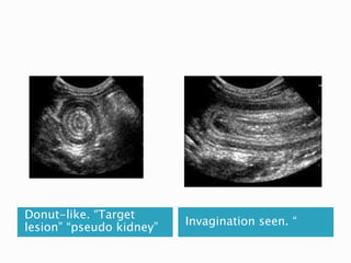 Donut-like. “Target
lesion” “pseudo kidney”
Invagination seen. “
 