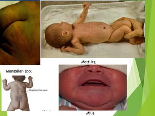 Mongolian spot
Mottling
Milia
14
 