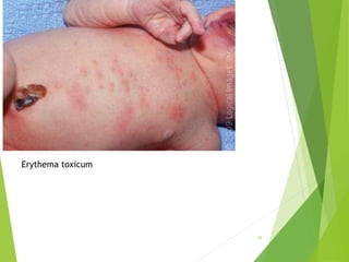 Erythema toxicum
15
 