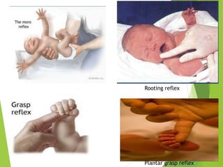 Rooting reflex
Plantar grasp reflex
34
 