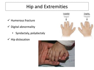 Hip and Extremities
 Humerous fracture
 Digital abnormality
• Syndactaly, polydactaly
 Hip dislocation
 
