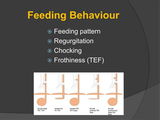 Feeding Behaviour
 Feeding pattern
 Regurgitation
 Chocking
 Frothiness (TEF)
 
